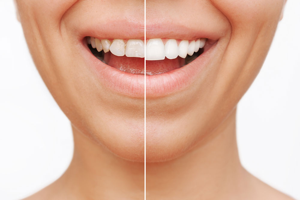 Porcelain Veneers in Austin, TX
